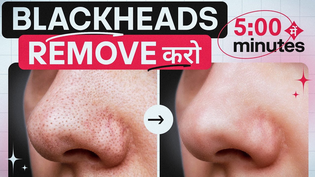 How To Remove Blackheads From Blackhead Remover Blackheads Kaise