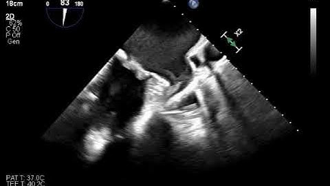 TEE LA appendage thrombus example 1