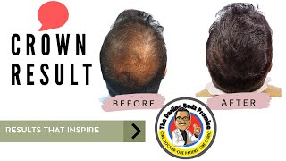 An amazing RESULT after hair transplant in India