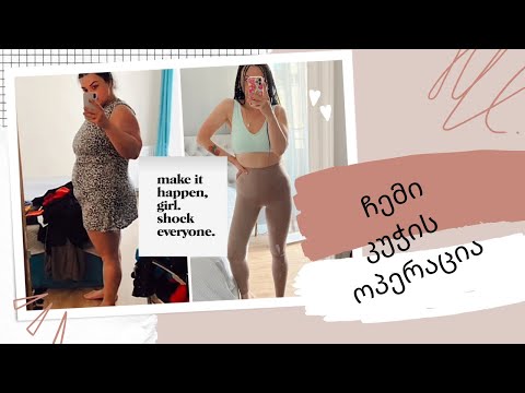 ჩემი ბარიატრიის ისტორია | ანუ როგორ დავიწყე ცხოვრება თავიდან |