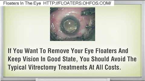 Do Floaters Go Away After Lasik