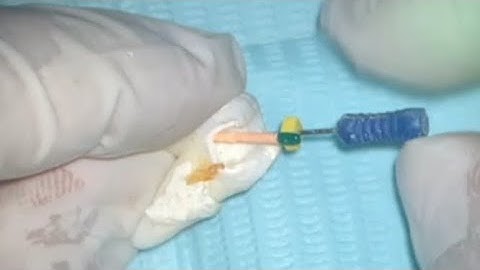 Root Canal Obturation , step by step