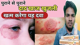 पुराने से पुराने दाद, खाज और खुजली जड़ से ख़त्म करेगा यह दवा | best cream for fungal infection