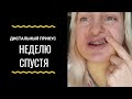 Дистальный прикус. Неделю спустя. Часть 4