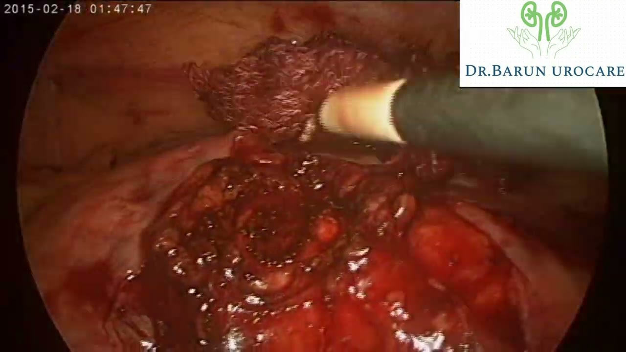Laparoscopic pyelolithotomy for pelvic fused kidney by Dr. Barun Kumar (consultant urologist)