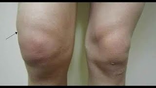 كيف نتخلص من ماء الركبة وإنصبابها..Knee joint effusion الدكتور عقبة نافع الناصري. Uqba N. Yousif