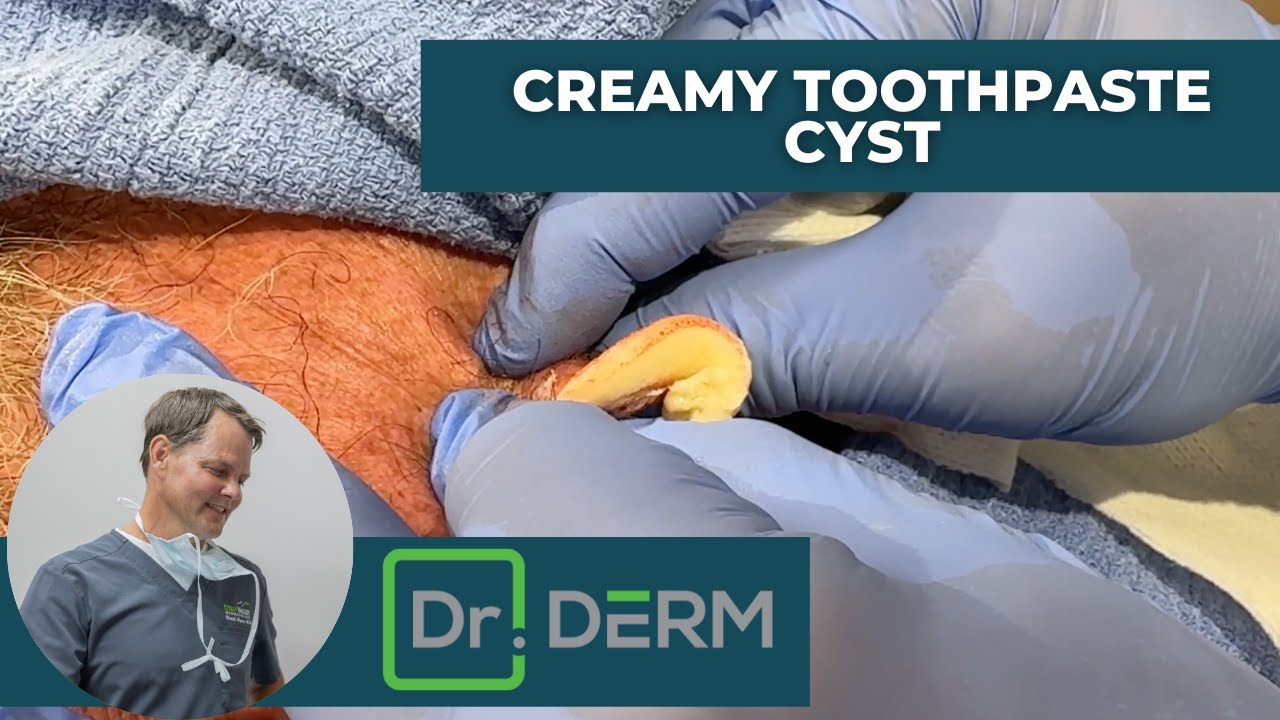 Creamy Toothpaste Cyst Dr. Derm YouTube