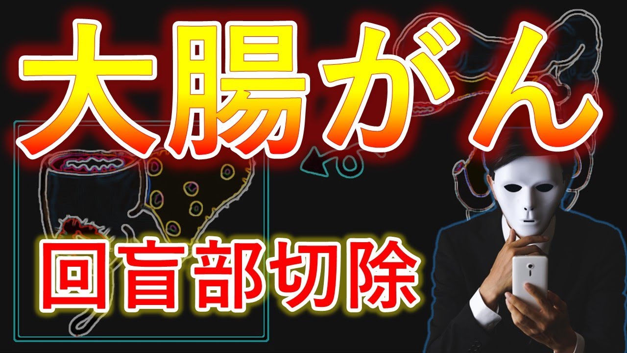 40代～70代必見！回盲部切除の恐るべき合併症と後遺症後遺症の全貌【医師解説】