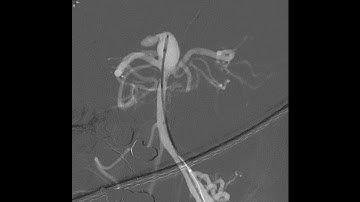 WEB device for intracranial aneurysms