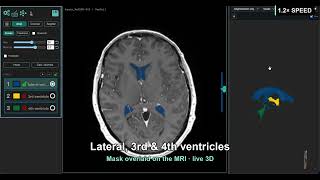 VoxTell in MedSeg: text-prompted 3D medical image segmentation