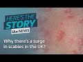 Why there’s a surge in scabies in the UK? | ITV News