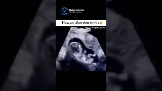 Download Lagu How an abortion works 😥#viralreels #trending #youtubeshorts #trendingshorts #ytshorts #youtube #yt 🖤 MP3