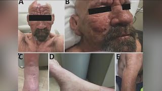 Central Florida sees a spike in leprosy | FOX 5 News