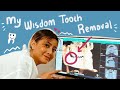 My Wisdom Tooth Removal - #KVLOG108