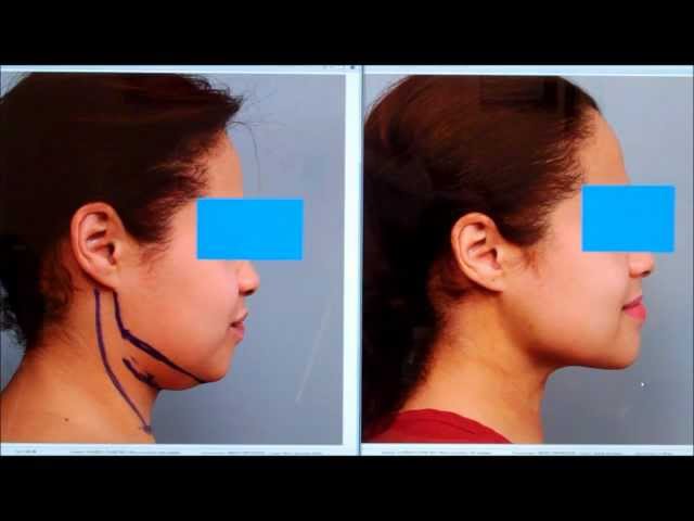 Sculpt the Chin & Neck With Liposuction