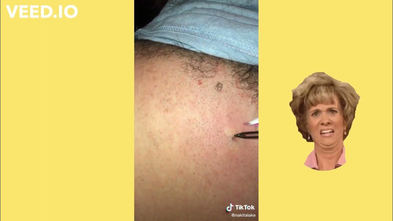 popping huge blackheads and pimples pimple popping best pimple