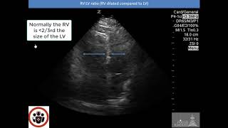 POCUS Cases 2: Pulmonary Embolism