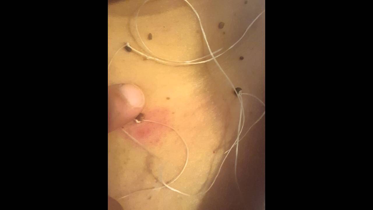 Skin tag removal - YouTube