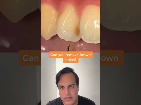 Can The Dentist Get Stains Off Teeth