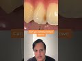 Cleaning brown spots on teeth #CleanTeeth #Teeth#DentalHygiene#WhiteTeeth