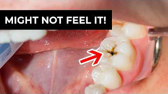 3 Ways to Tell If You Have a Cavity (Before It Hurts!)
