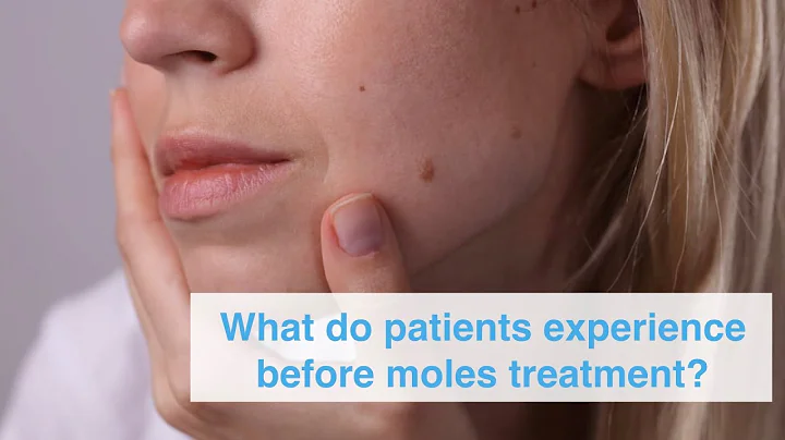 What do patients experience before moles treatment?
