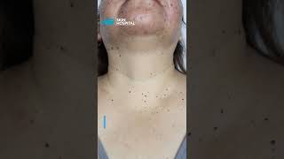 Elimina las verrugas del cuello | Skin Hospital | #dermatologia