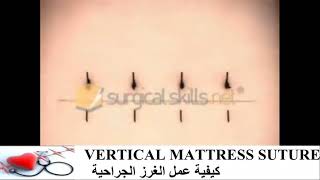 كيفية عمل الغرز الجراحية VERTICAL MATTRESS SUTURE Animation