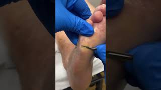 Take A Step Towards Feet Relief! Watch Aussie Podiatrist Remove Forefoot Callus!