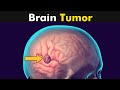 What happens in brain tumor  symptoms and causes 3d animation