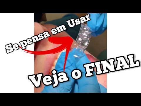 Vídeo: Como os anexos funcionam invisalign?