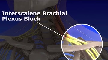 Interscalene Brachial Plexus Block