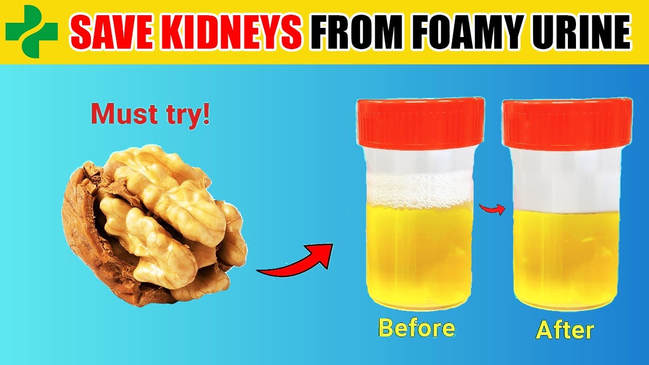 Top 6 Super Foods To Help Stop Proteinuria and Heal Your Kidneys ...