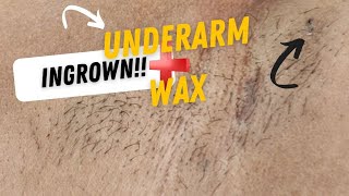 Underarm wax & Ingrown❗