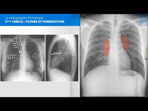 Vidéo: Bénéfice Clinique Extraordinaire Pour Un Traitement Séquentiel Avec Une Thérapie Ciblée Et Une Immunothérapie D'un Adénocarcinome Pulmonaire Métastatique Positif BRAF V600E Et