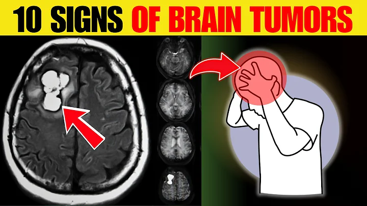 Top 10 Warning Signs of Brain Tumors
