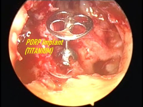Endoscopic PORP placement | Intact canal wall MRM : CASE 3