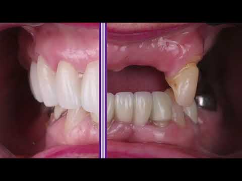 Before And After Partial Denture Replaced By A Zirconia Lingual With Ceramic Bridge Transformation