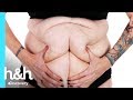 Aprovada para a cirurgia | Emagreci, E Agora? | Discovery H&H Brasil