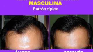 Alopecia androgenética en Causas, formas clínicas - YouTube