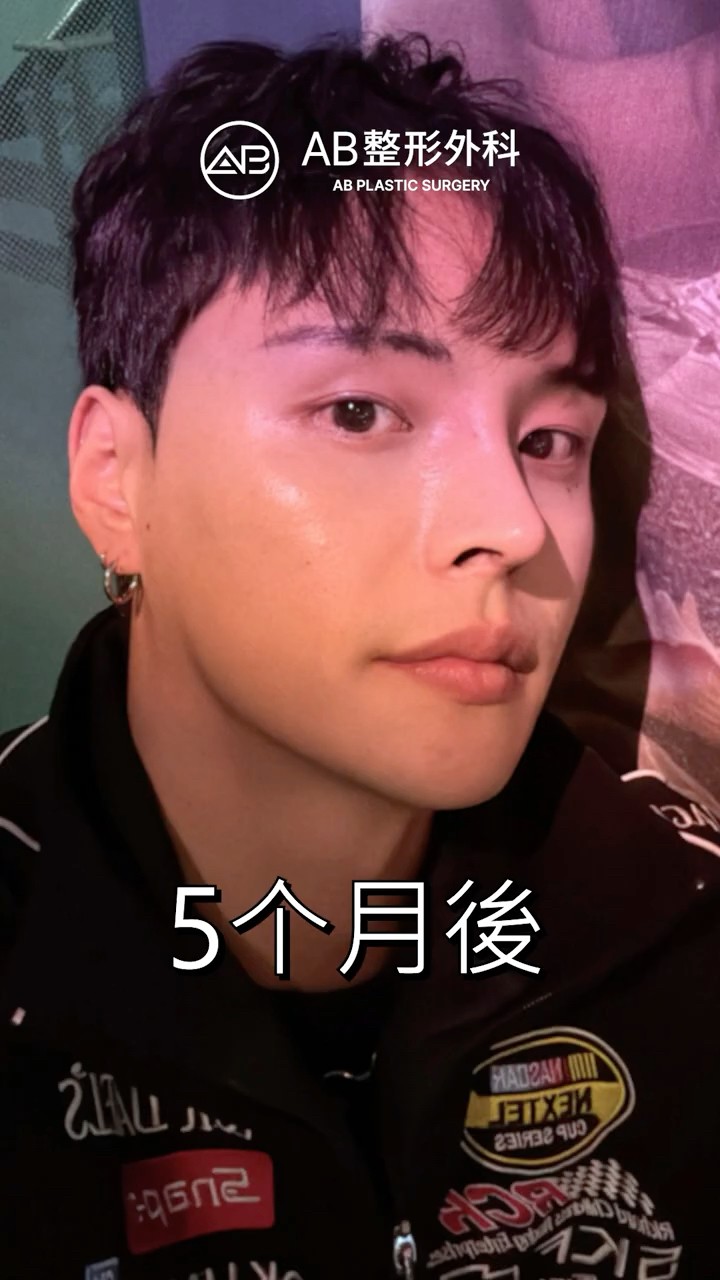 男性輪廓三件套 眼整形 鼻整形 1至5個月恢復過程公開 #shorts