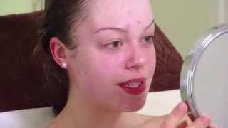 DMK's Acne Treatment: Sarah's Story