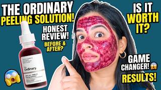 The Ordinary Peeling Solution Review | The Ordinary AHA 30% + BHA 2% Peeling Solution | Worth it?