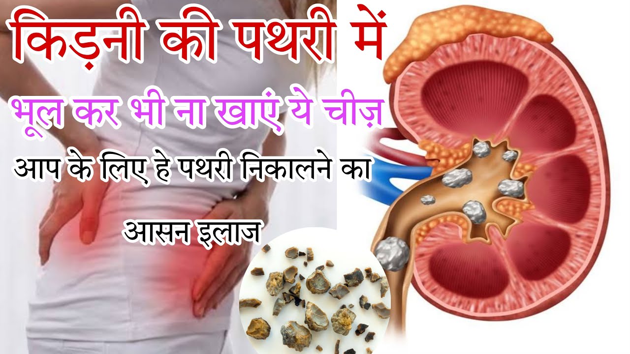kidney ki pathri kaise nikale !kidney ki pathri kaise hoti hai !kidney