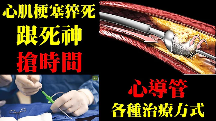 和死神抢时间！心脏梗塞猝死，心导管微创治疗的各种方式｜许原彰医师：高雄宇成诊所 - 天天要闻