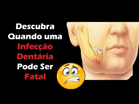 Vídeo: Sintomas De Infecção De Dente Se Espalhando Para O Corpo