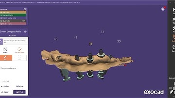 Exocad tutorial | Implant restoration All On Five #exocad GmbH #smile #dental