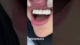 زراعة اسنان فك علوي كامل في الرياض عيادات عاجي لطب الاسنان فرع الروضة افضل دكتور زراعة 0565606434