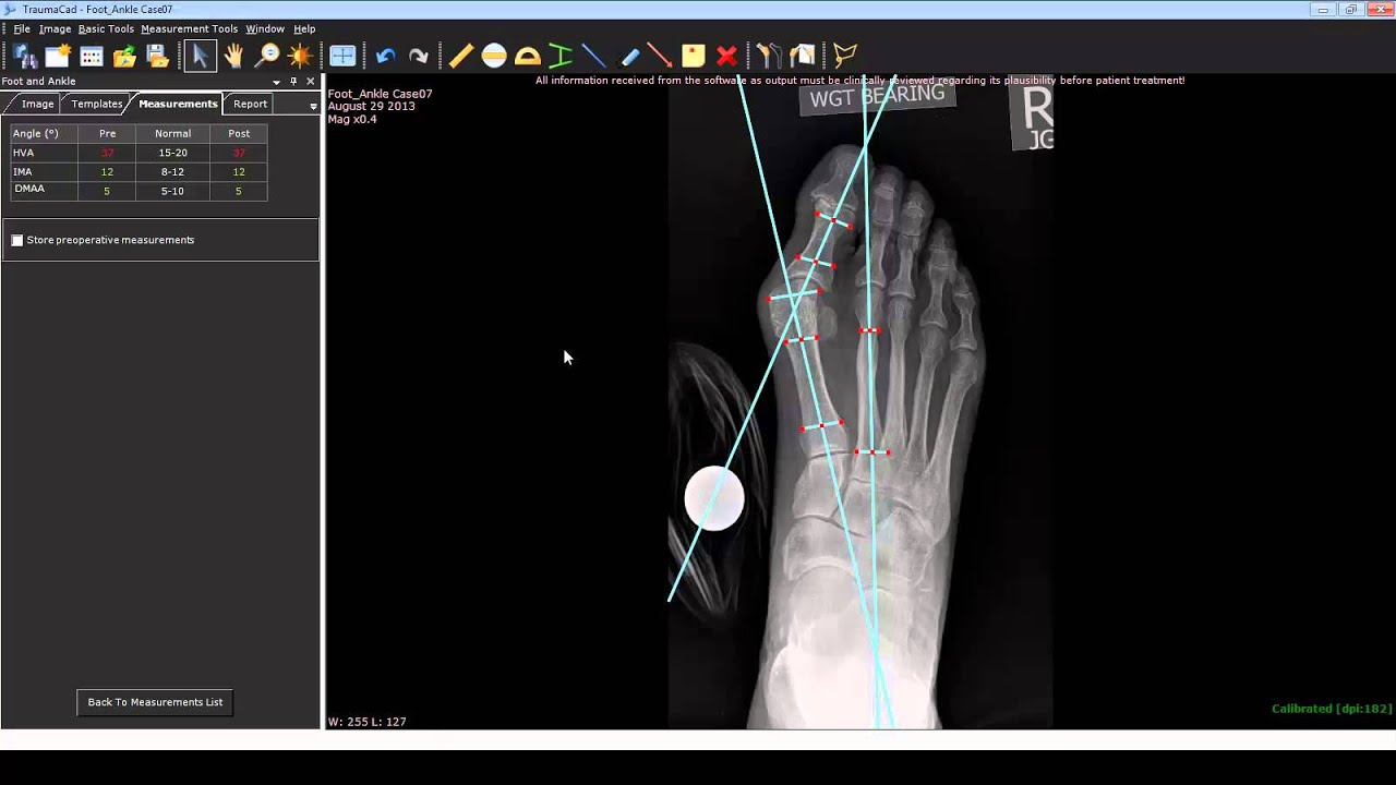 Foot and Ankle Deformity Correction with Dr. Noman Siddiqui - Bunion Correction