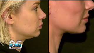 Ariana Madix (Vanderpump Rules) getting Elevate & Facetite for Jawline Definition (2019) Content